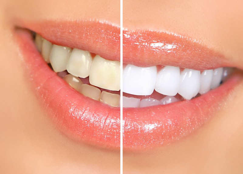 Teeth Whitening  State College, PA, 
