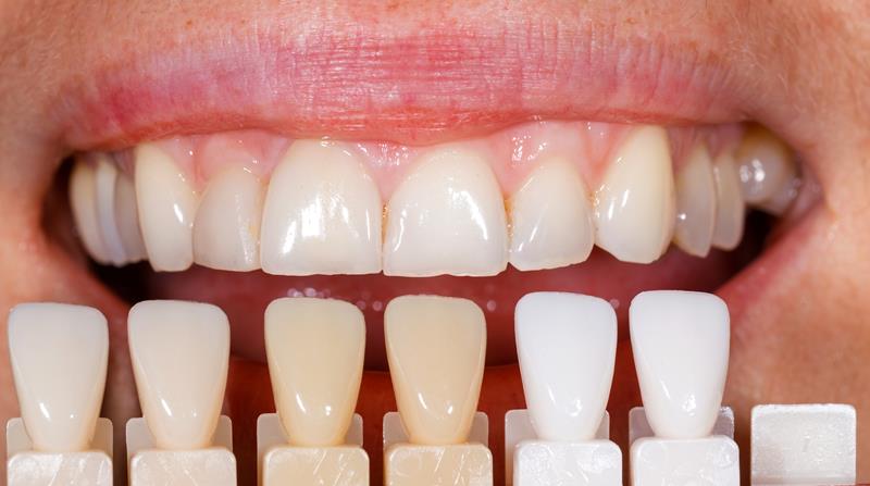 Veneers  State College, PA, 